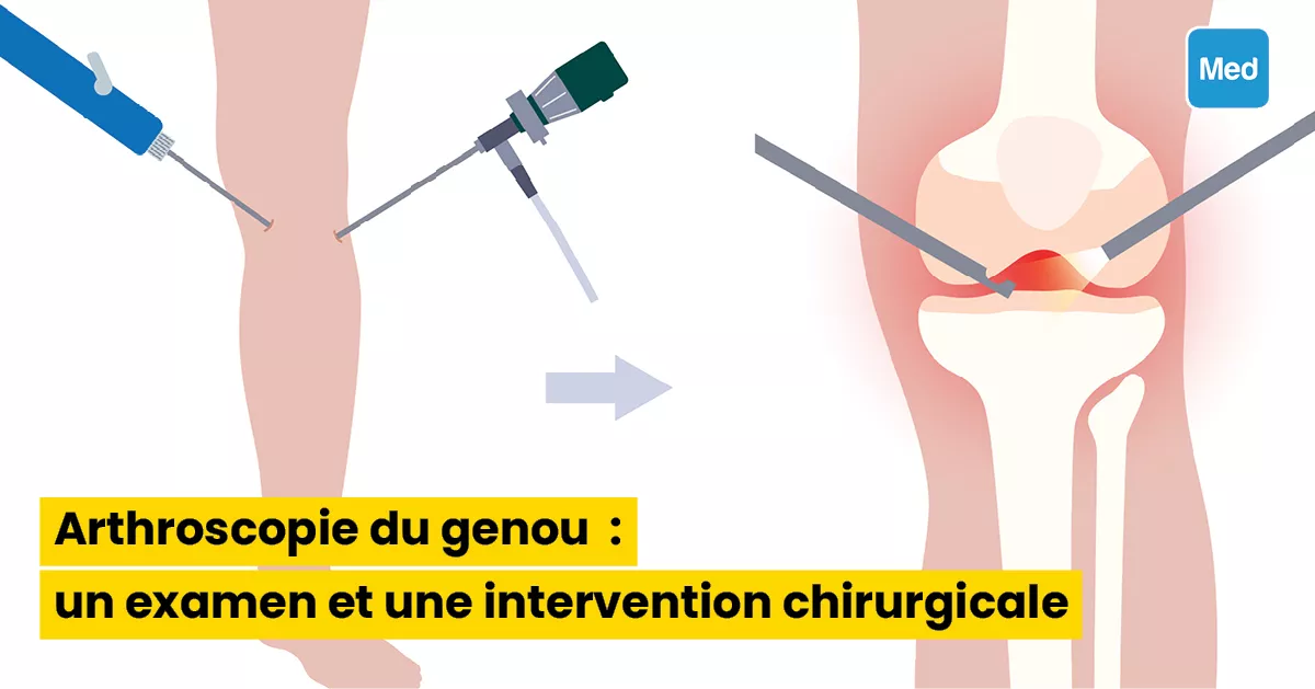 Arthroscopie du genou : un examen et une intervention chirurgicale